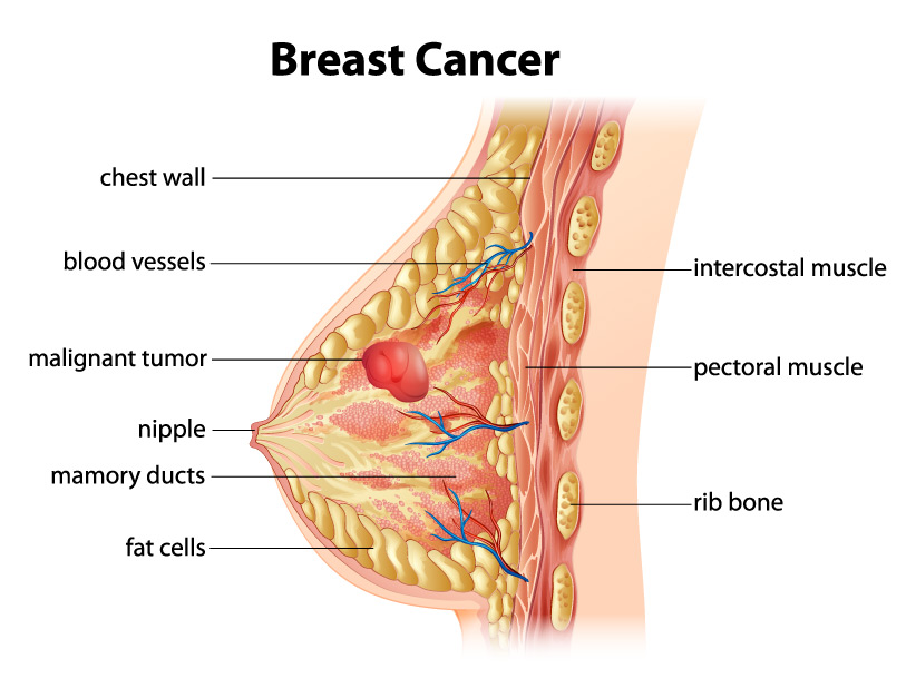 Benign breast disease